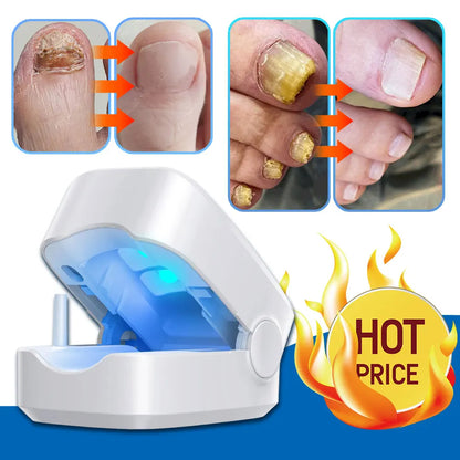 Nail Fungus Laser